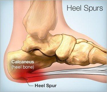 Spør ekspertene: Hvordan lindrer jeg hælsporen min? 29 Heel Spurs